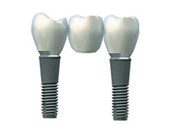 http://www.drs-martinet-jacquin-chirurgiens-dentistes.fr/wp-content/uploads/2011/12/implants-bridge-big.jpg