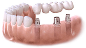 Pose d'un bridge sur implants dentaires