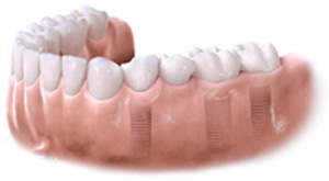 Bridge en céramique sur implants dentaires