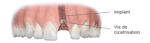 Pose de l'implant dentaire et de sa vis de cicatrisation