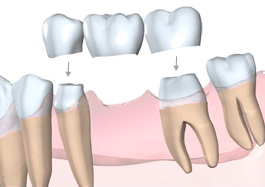 Pose d'un bridge dentaire