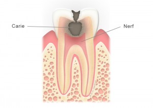 Dent cariée (molaire)