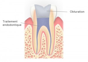 Dent dévitalisée (molaire) avec obturation
