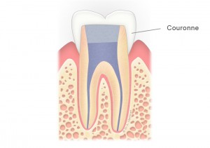 Dent dévitalisée couronnée