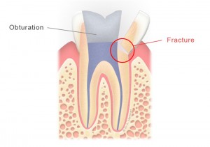 Dent dévitalisée fracturée