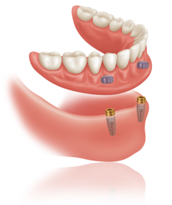 Dentier fixé avec des implants dentaires