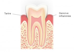 Dent avec gingivite et tartre