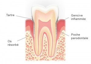 Dent avec parodontite et poche parodontale