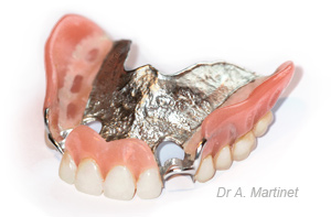 Prothèse dentaire métallique ou stellite supérieur