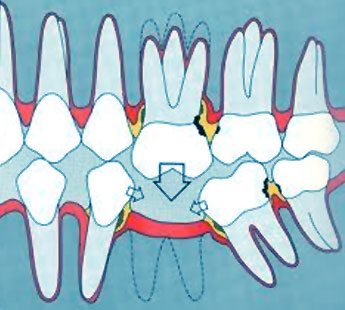 Les conséquences du non-remplacement d'une dent manquante